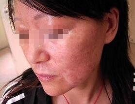 武汉如何预防女性白斑的二次复发？