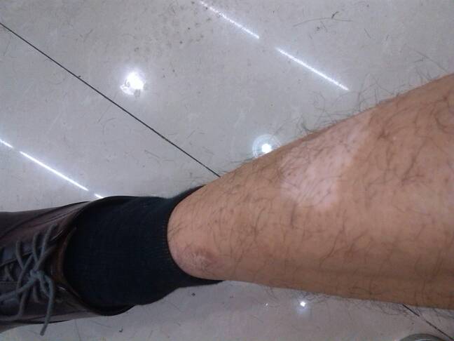 武汉腿上长了白斑患者要怎么进行治疗呢？